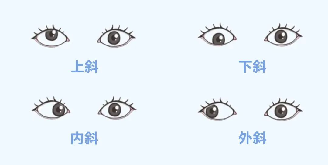 儿童斜视危害远超你想象!把握寒假矫正好时机,越早治疗越好!