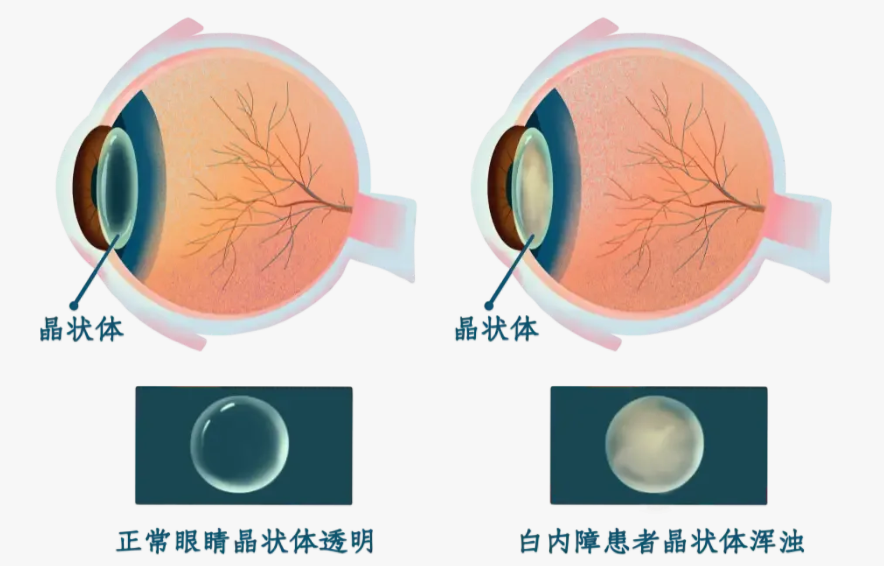 告别两副眼镜困扰！「屈光性白内障手术」助你远中近全程好视力→