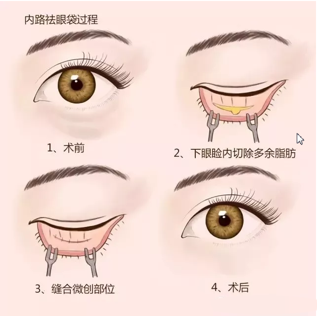 想Get妈生感自然双眼？眼整形攻略一次性讲透！